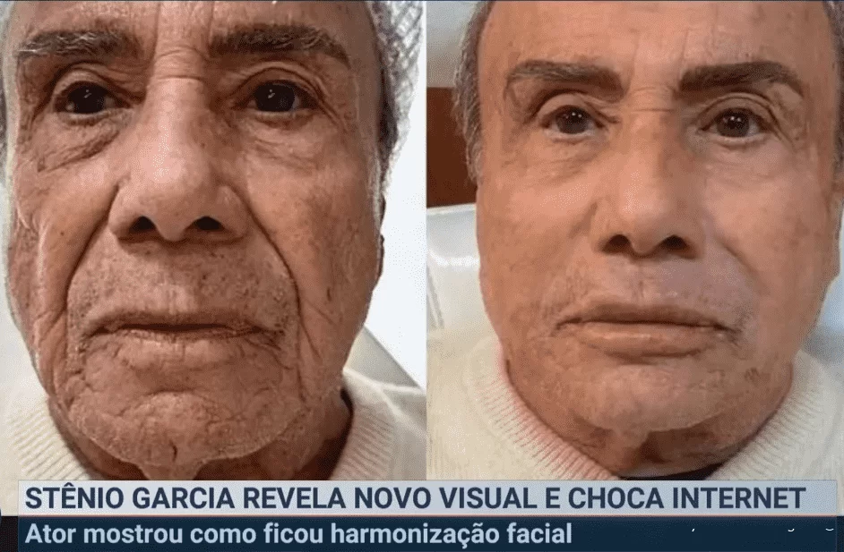 Омоложение привело звезду «Клона» на больничную койку